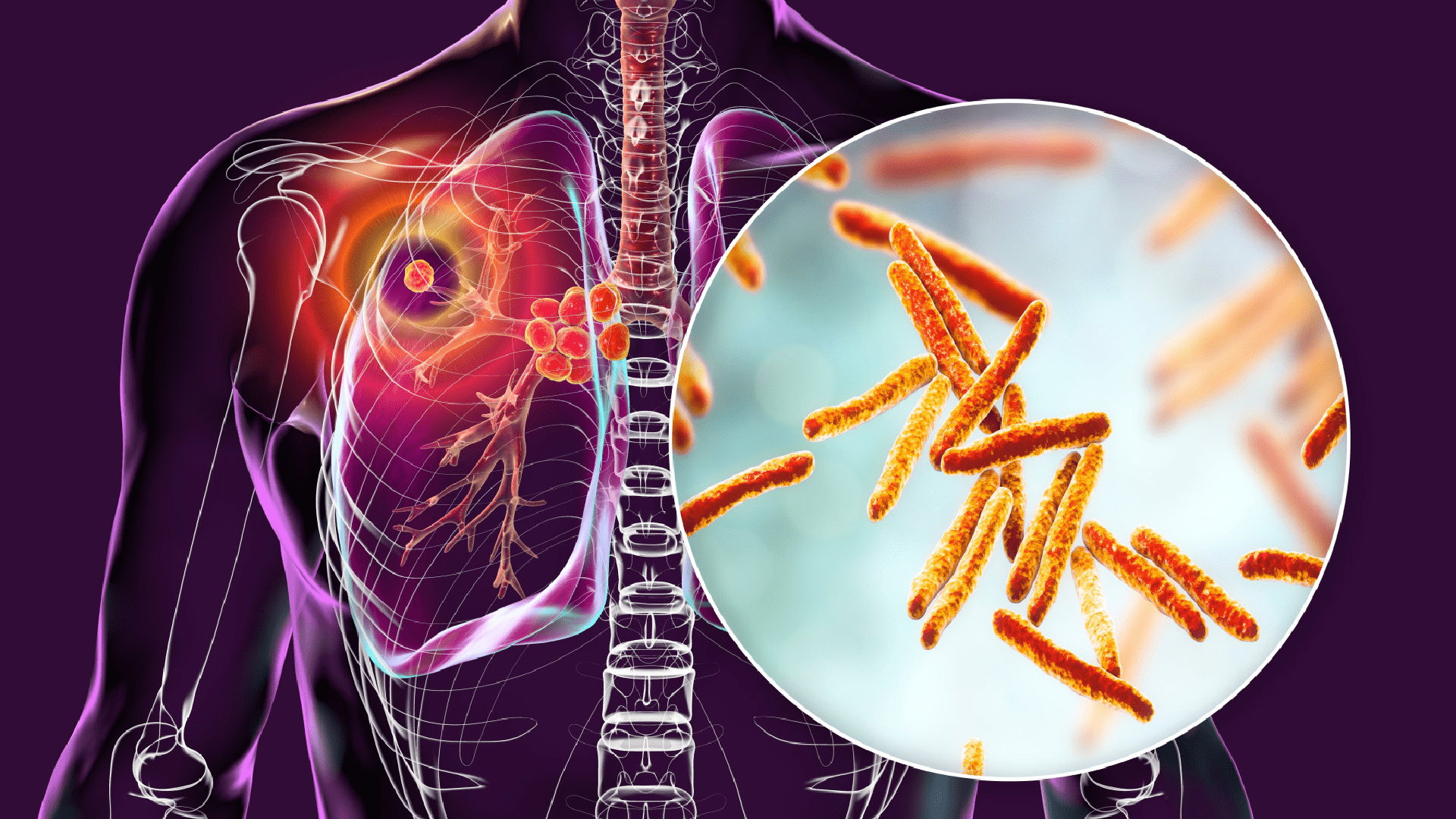 Cache Creek Casino Resort Confirms Case of Contagious Tuberculosis